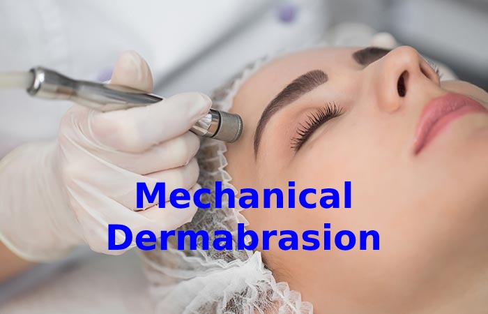 Mechanical Dermabrasion Acne scars