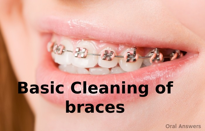 Basic Cleaning of braces Smile with Braces