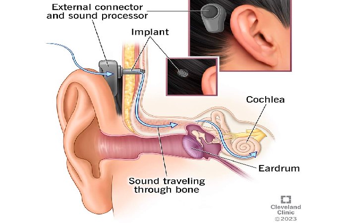 Hearing Aids Write For Us