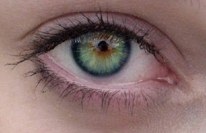 Central Heterochromia Write For Us
