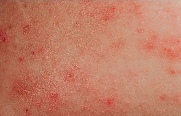 Skin Rashes